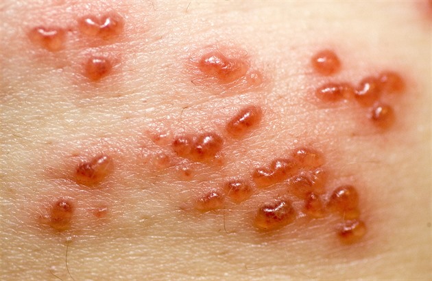 Pásový opar není jen vyrážka. Pravda o bolestivém onemocnění