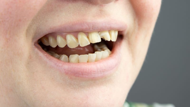 Příčiny žloutnutí zubů? Odborníci upozornili na šest chyb, které ničí bílý úsměv každý den