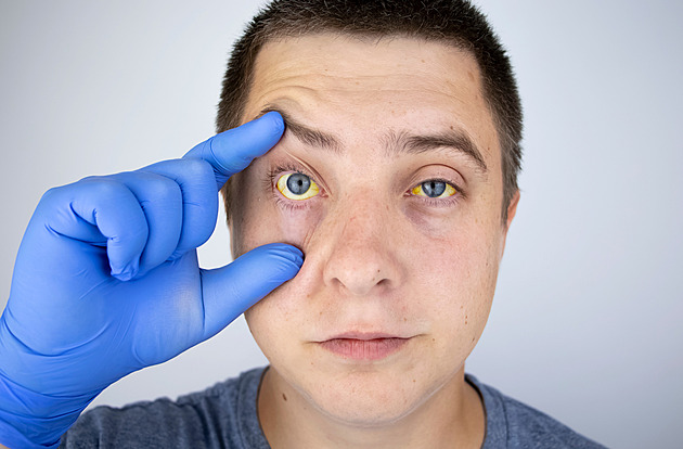 Žloutenka A nečekaně sílí. Epidemie trvá už třetí rok, zemřely desítky lidí